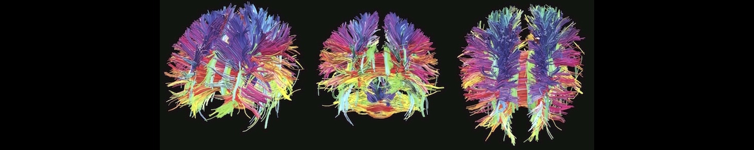 Diffusion tensor imaging image