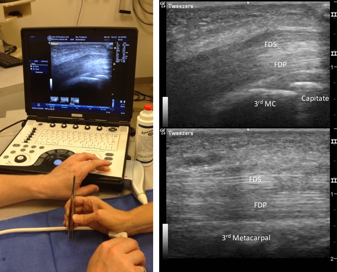 Using sonography to connect the mind-body using biofeedback with visualization of sliding of the flexor digitorum superficialis (FDS) and profudus (FDP) during tweezer use